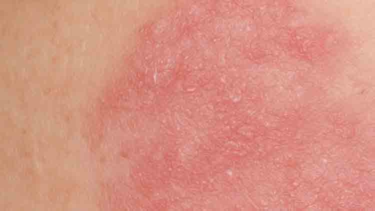 Tras creación del programa provincial de Dermatitis Atópica, aumentaron las consultas